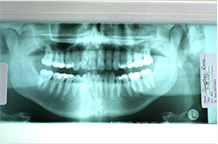 Root Canals Sterling Heights, MI
