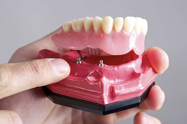 implant retained dentures Clinton Township, MI