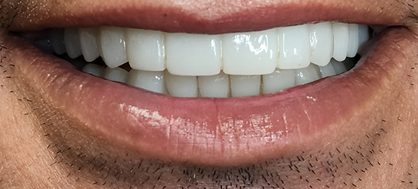 10-after