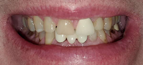 2-before