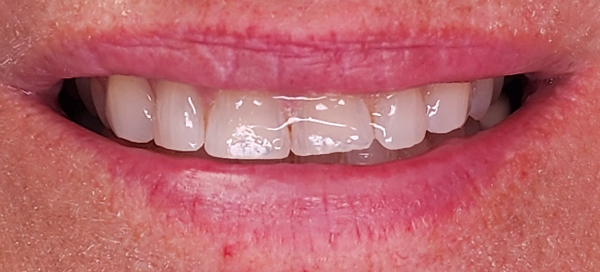6-before