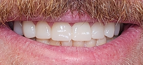 7-after